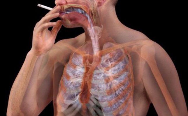 Ung thư phổi tế bào không nhỏ 