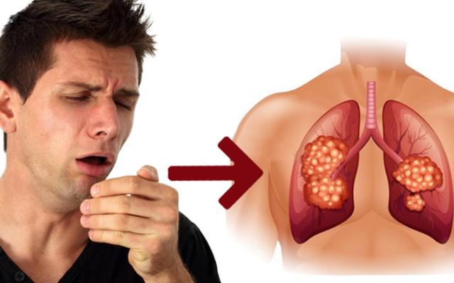 Đặc điểm của ho trong ung thư phổi là gì? 
